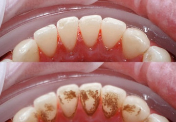 Cao răng hình thành từ đâu <<< Phân tích từ chuyên gia