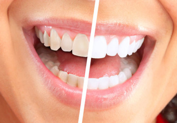 Các cách làm trắng răng hiệu quả  trắng bóng sau 5 phút